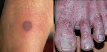 fusarium disease-skin